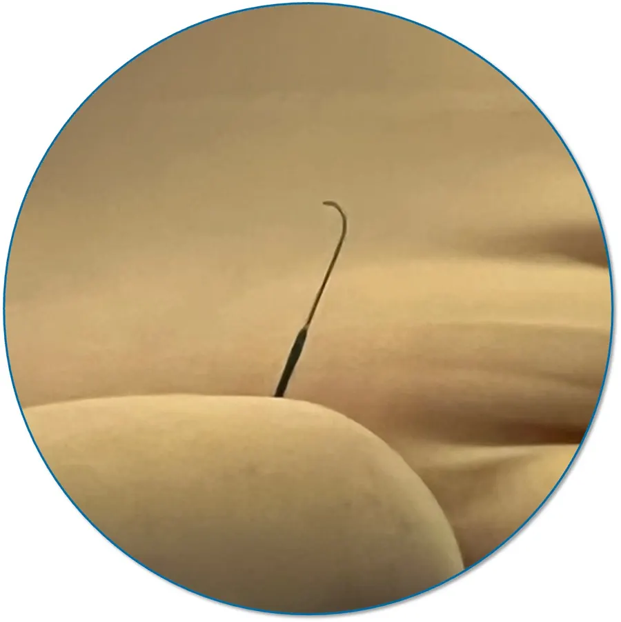 WaveSelect shaped tip